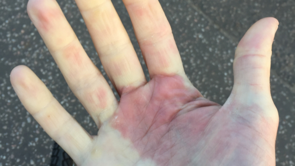 Vita fingrar (Raynauds fenomen): orsak, symtom & behandling